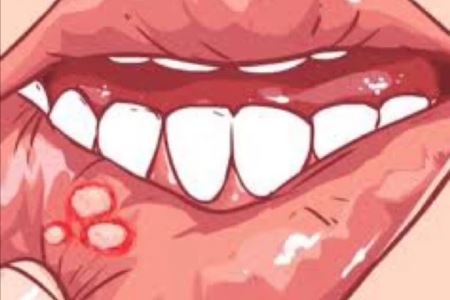 口腔溃疡就是缺维生素?谣言~更多是这4个原因