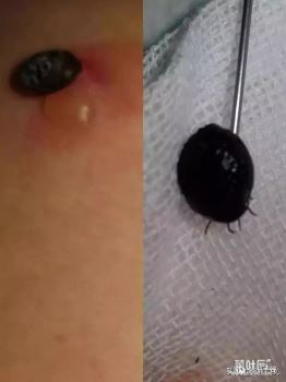 蜱虫用东西烫 被蜱虫咬后伤口的图片