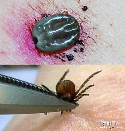 蜱虫钻入皮肤内的症状 蜱虫口器断在皮肤图片