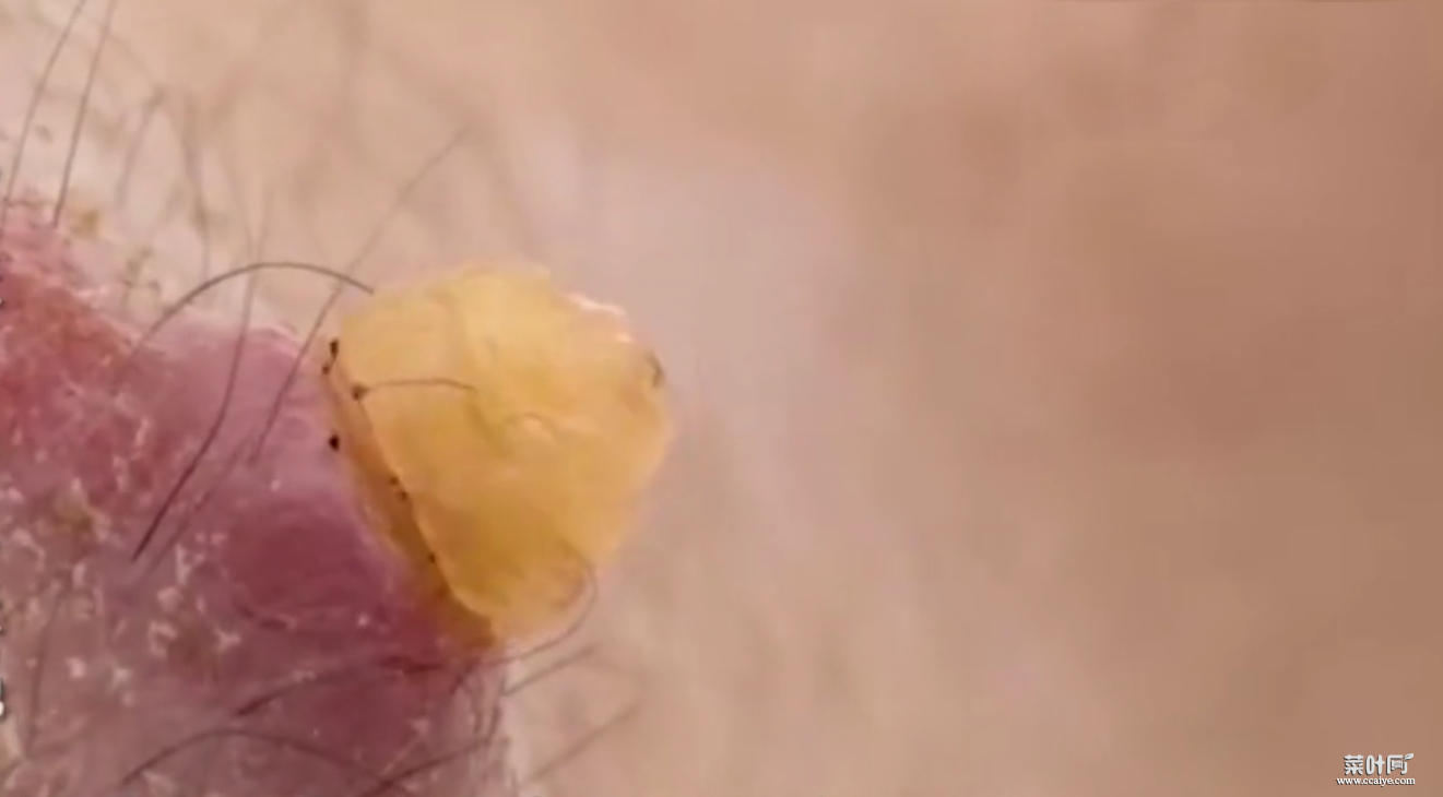 皮蝇是如何进入皮肤的 史上最恶心蝇蛆病