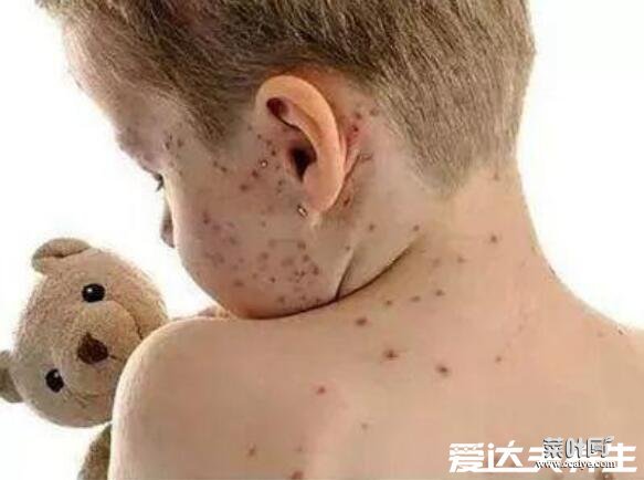 水痘的7天演变过程图片，护理方法得当一周就能痊愈不留疤痕