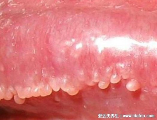 假疣和真疣的区别：珍珠疹和菜花样尖锐湿疣一眼能分辨