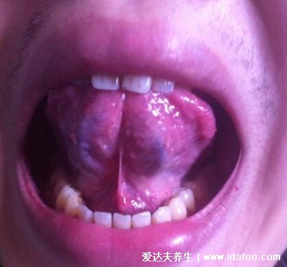 舌头下面血管发紫发黑图片