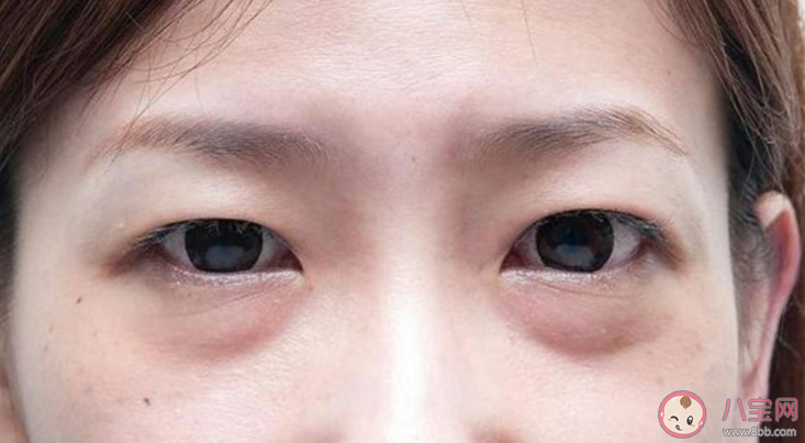 黑眼圈长期消不掉有哪些可能 不同类型黑眼圈怎么解决