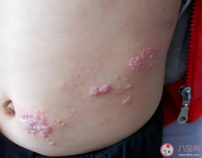 哪些人易感染带状疱疹 如何日常生活中预防带状疱疹